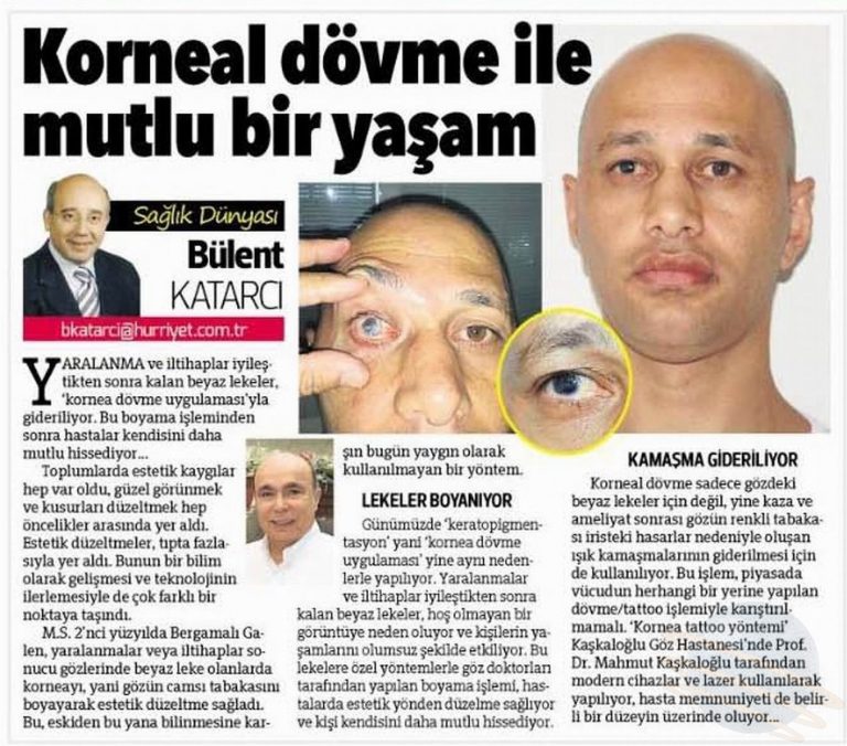 Korneal dövme ile mutlu bir yaşam