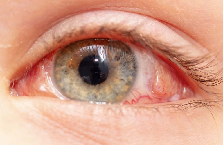 Göz Titremesi Nistagmus