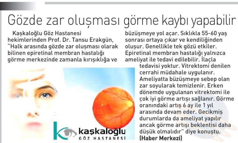 Gözde zar oluşması haberi