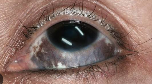 What Is Nevus of Ota?
